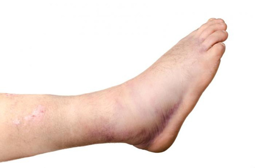 Image result for ‫درمان ورم مچ پا‬‎