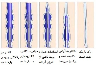 ابلیشن رادیوفرکوئنسی (الکتروکوتر)