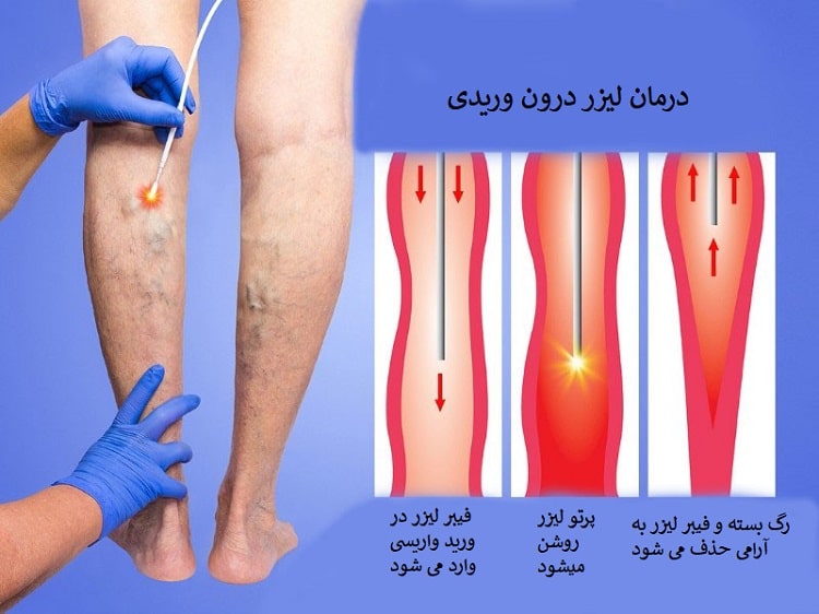 درمان بیرونزدگی رگهای پا و ران و زانو