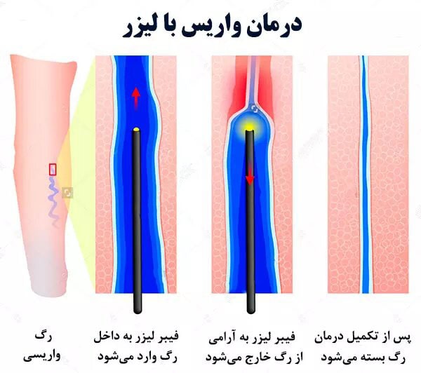 درمان واریس با لیزر