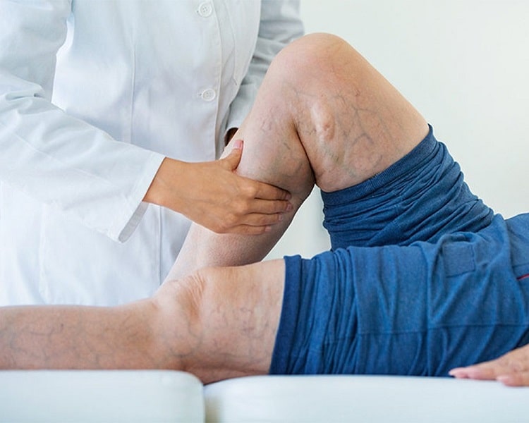 درمان واریس با ماساژ