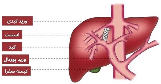 شنت پورتوسیمتیک داخلی کبدی داخل جفتی (TIPS)
