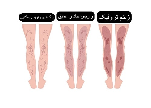 علائم انواع رگ های واریسی