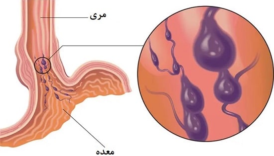 علت واریس مری