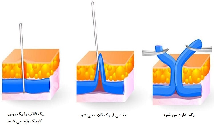 فلبکتومی