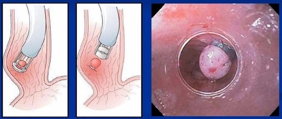 لیگاسیون واریس