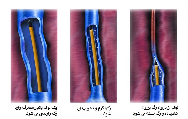 نحوه درمان رگ های واریسی با RF چگونه است؟