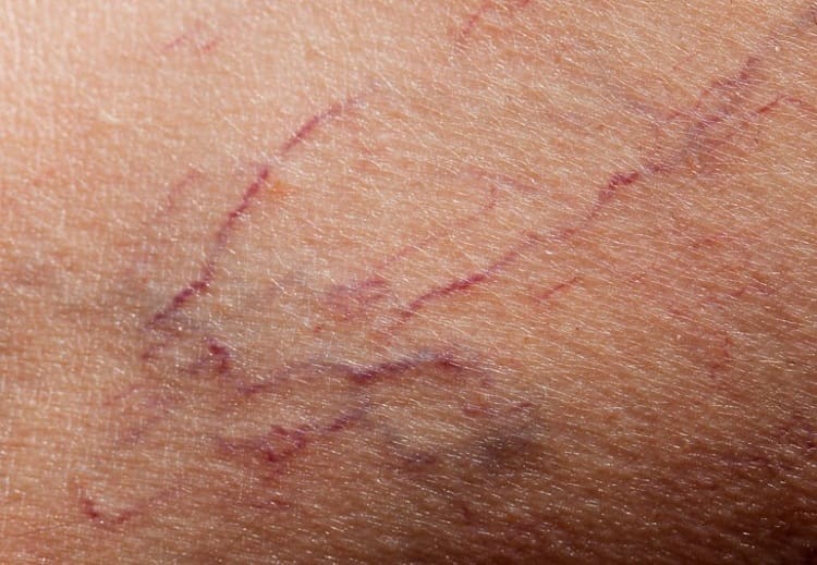 رگ‌های بنفش و آبی و قرمز واریسی