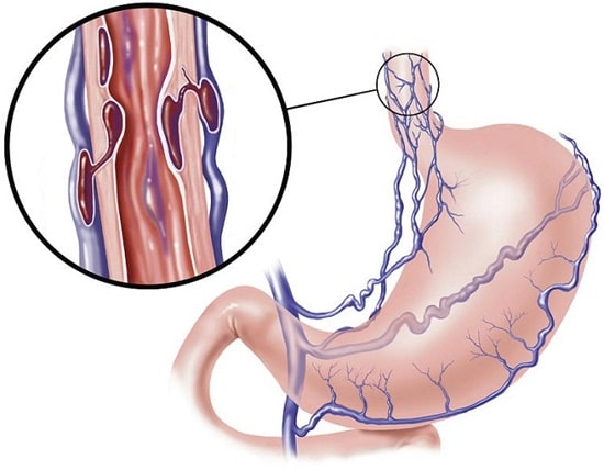 واریس مری: علل، علائم، درمان و مراقبت ها